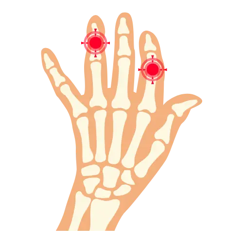 Artritis