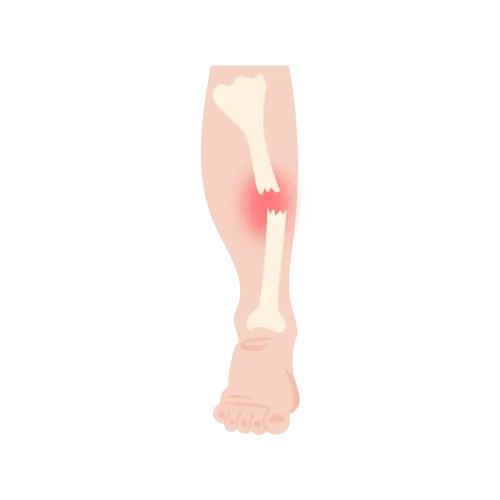 Fracturas