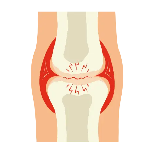 Osteoartritis