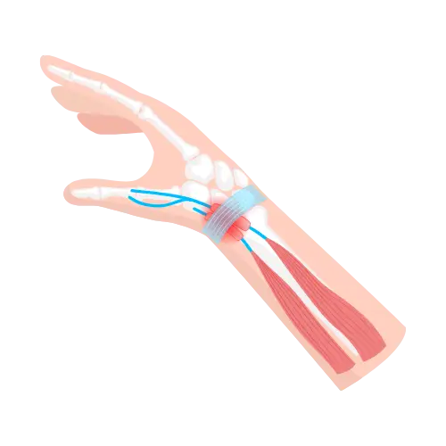 Tendinitis