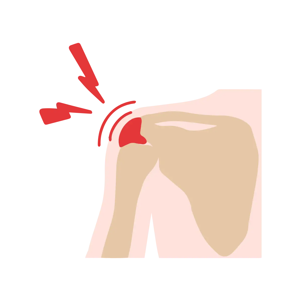 Bursitis